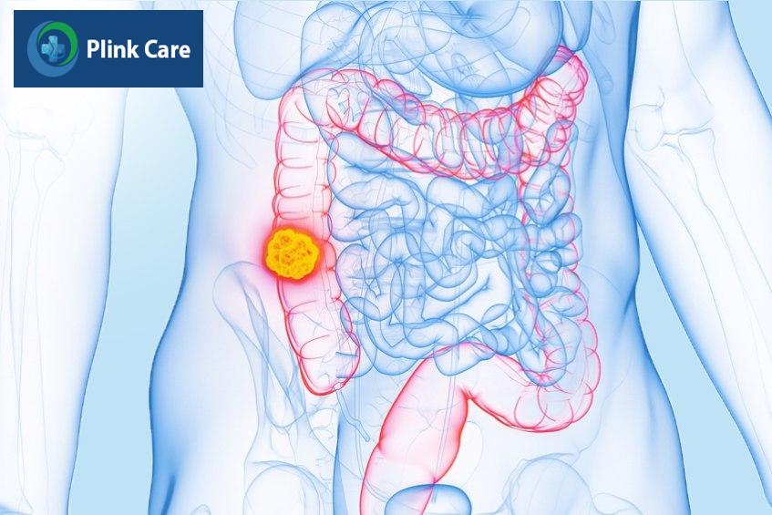 mô phỏng khối ung thư đại tràng cần khám ngay
