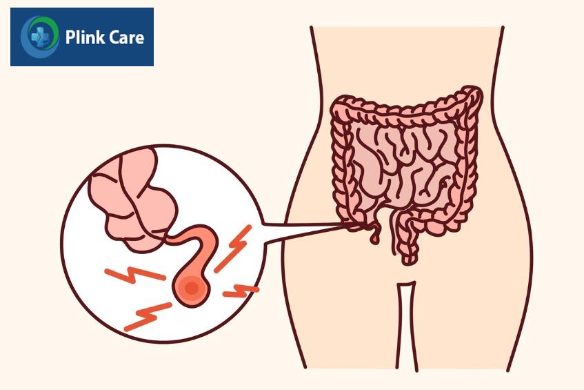 nguyên nhân phổ biến gây đau bụng dưới bên phải