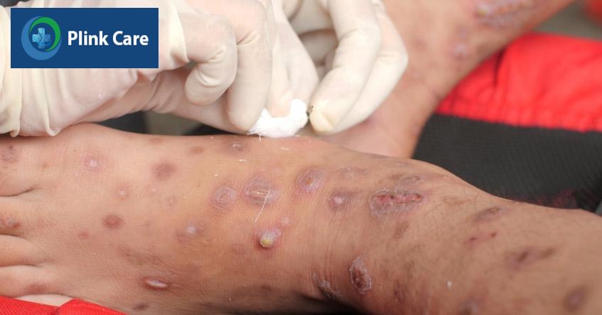 nhiễm trùng thứ phát do bệnh ghẻ gây ra