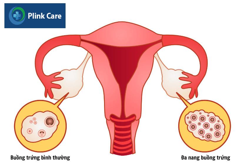 Nỗi lo không rụng trứng của nhiều chị em mắc buồng trứng đa nang