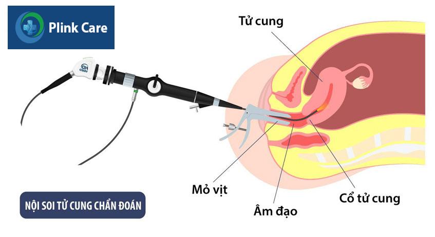 nội soi buồng tử cung