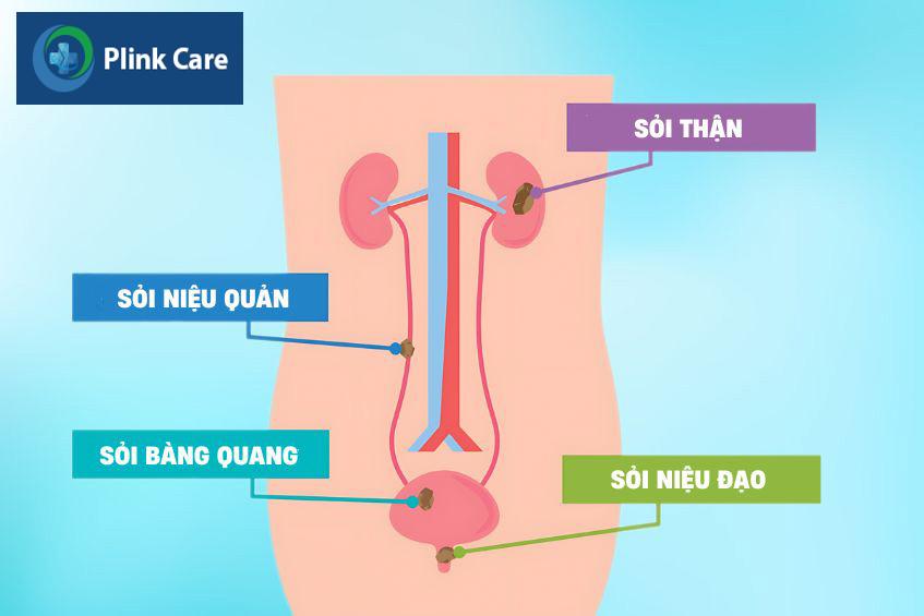 phân loại sỏi tiết niệu theo vị trí