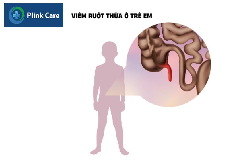 phần ruột nhỏ nối với ruột già, phía dưới bụng bên phải bị viêm