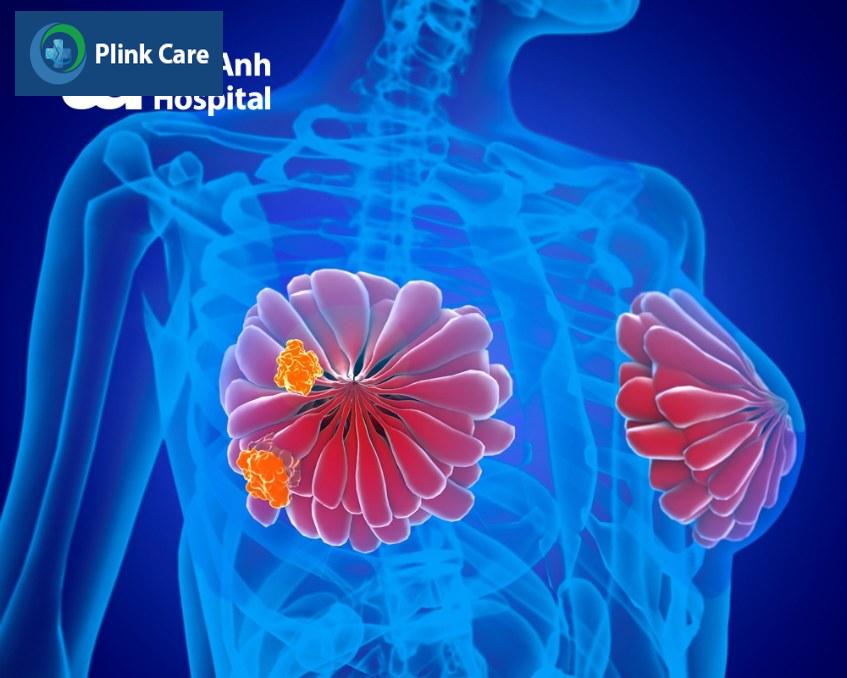 phẫu thuật cắt tuyến vú phụ
