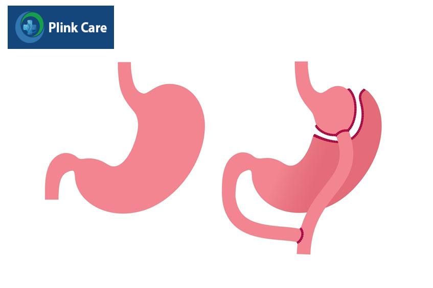 Phẫu thuật nối tắt dạ dày là một trong các phương pháp phẫu thuật