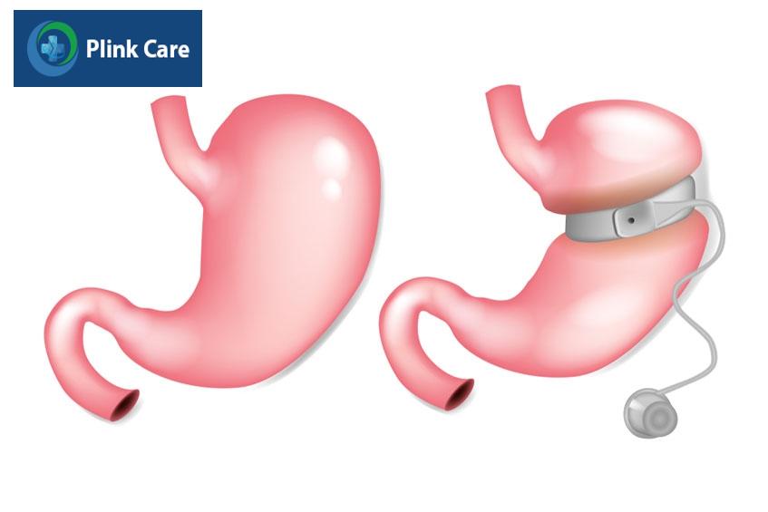 Phẫu thuật thắt đai dạ dày có nhiều ưu điểm
