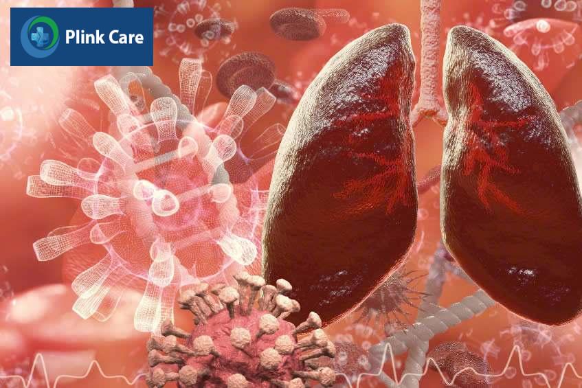 Phổi bị viêm có thể do nhiều loại virus viêm phổi gây ra