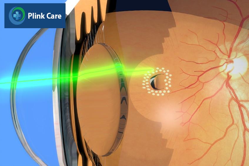 quang đông laser điều trị rách võng mạc