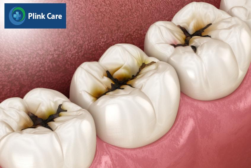 Tại sao răng bị xỉn đen? Sâu răng