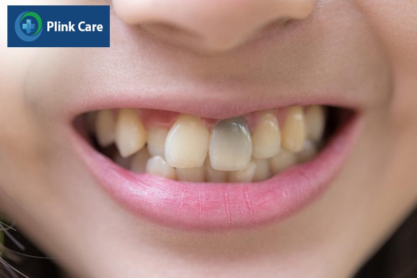 Răng bị đen là gì? Các dấu hiệu thường gặp