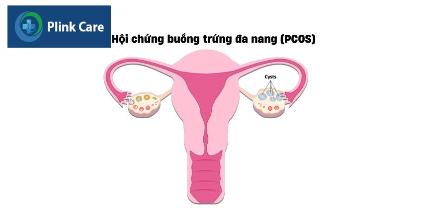Rối loạn chu kỳ kinh nguyệt là một trong những biểu hiện của đa nang buồng trứng