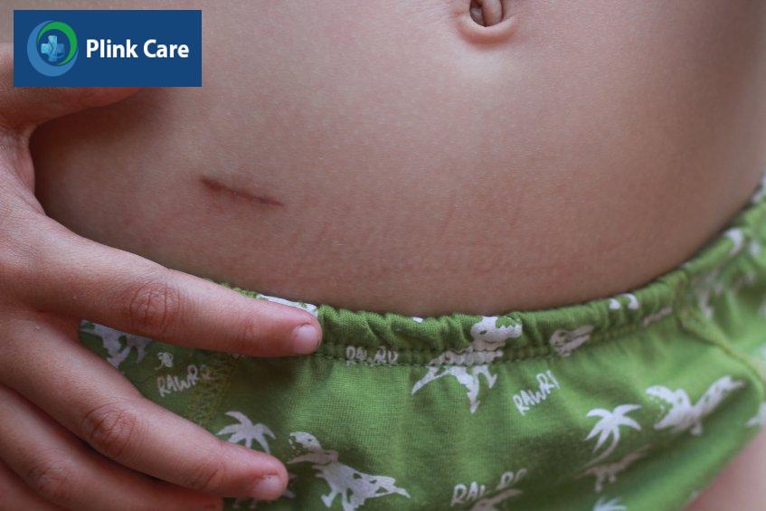 Sẹo để lại do phẫu thuật viêm ruột thừa ở trẻ