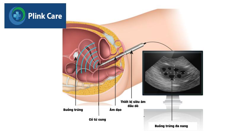 Siêu âm đầu dò âm đạo giúp phát hiện đa nang buồng trứng