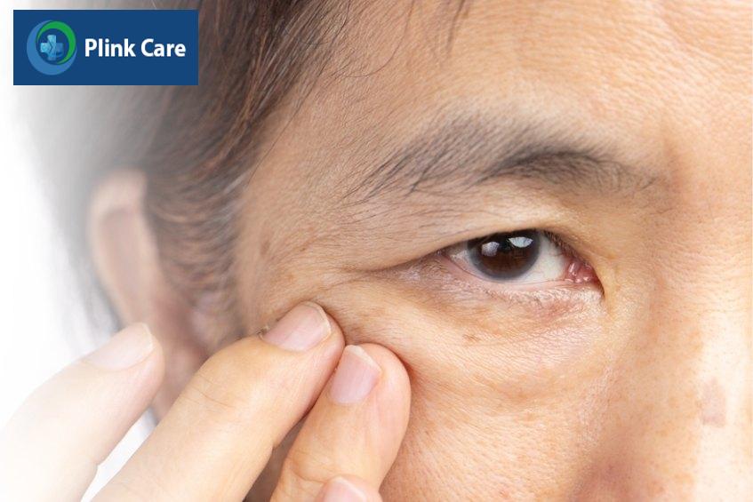 sụp mí mắt tự khỏi phụ thuộc vào nguyên nhân