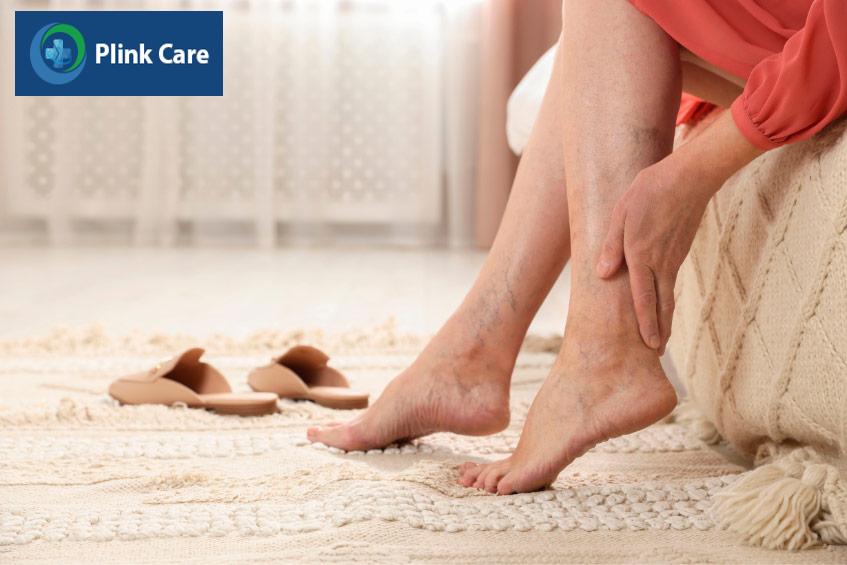 Suy giãn tĩnh mạch ở chi dưới gây mất thẩm mỹ và đau nhức cho người bệnh