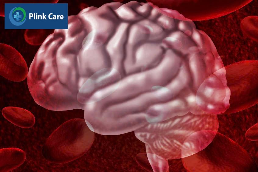 tìm hiểu xuất huyết não và cách điều trị hiệu quả