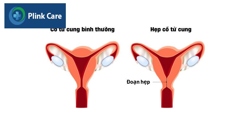 tình trạng cổ tử cung hẹp ở phụ nữ