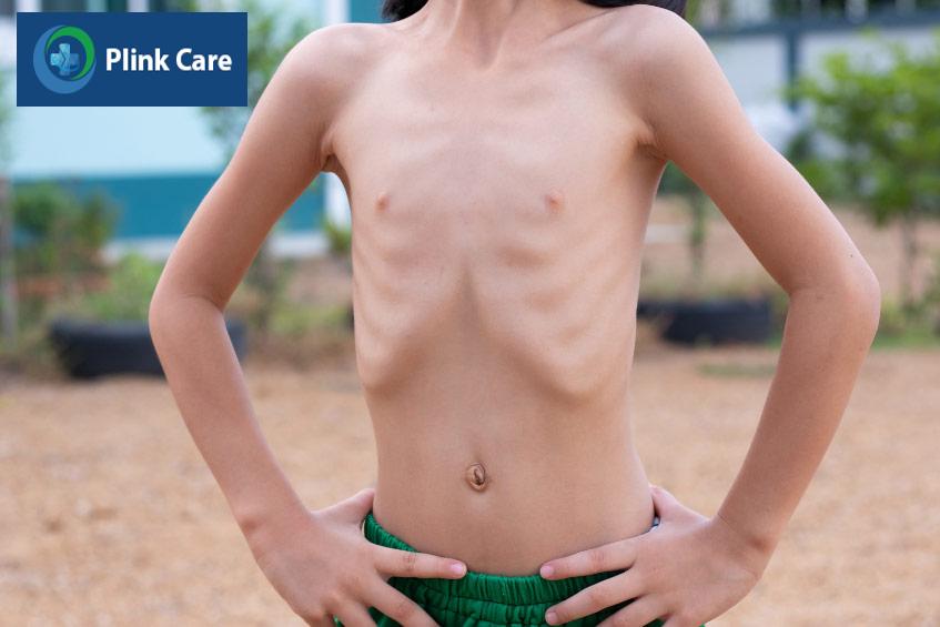 trẻ còi xương suy dinh dưỡng