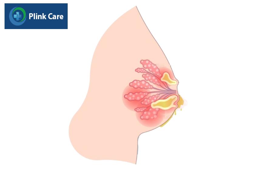 triệu chứng của ung thư vú