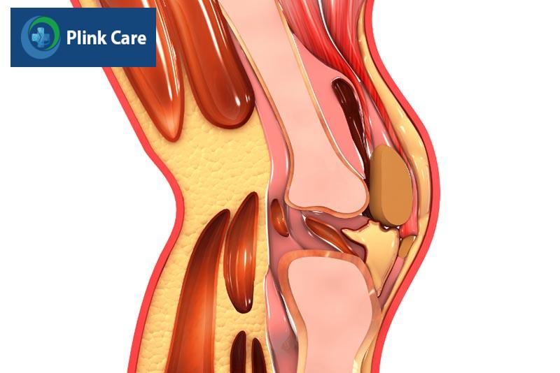Triệu chứng viêm cơ làm giảm tầm vận động của khớp gối