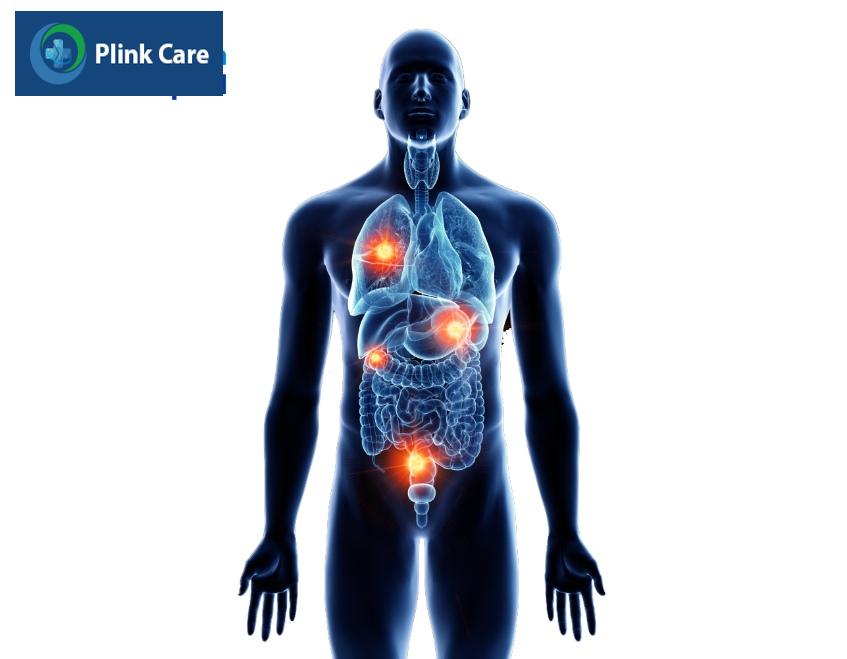vị trí ung thư trực tràng di căn phổ biến