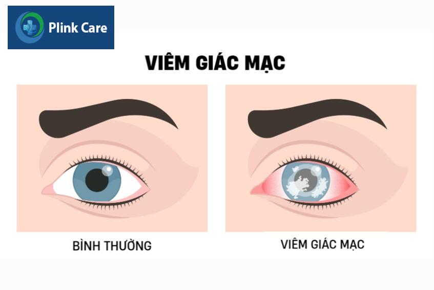 Viêm giác mạc gây cảm giác cộm, khó chịu ở mắt, đỏ mắt