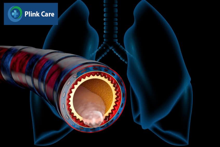 Viêm phế quản cấp là tình trạng bệnh lý phổ biến