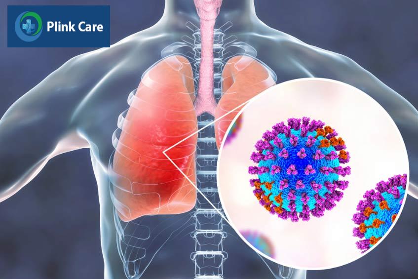 virus a h3n2 là một phân nhóm cúm a