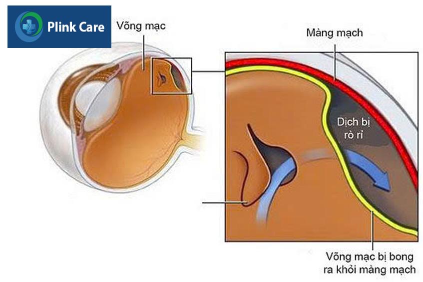 võng mạc bong khỏi màng mạch