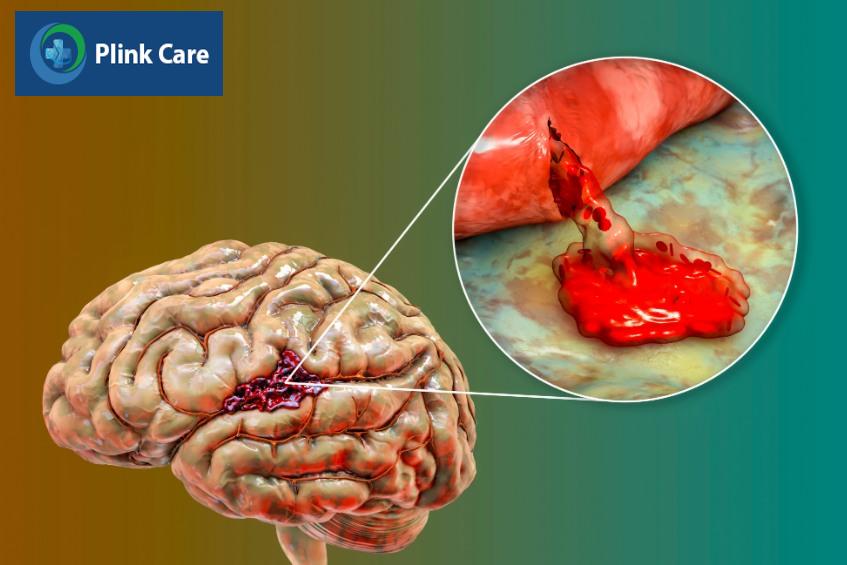 xuất huyết não gây tổn thương não