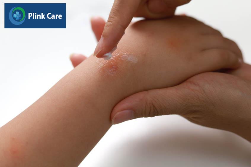 Bôi thuốc trị phỏng bô cho trẻ theo chỉ định của bác sĩ