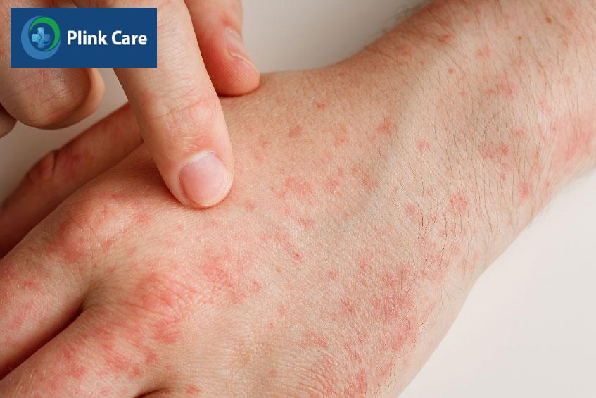 Bệnh nhân bị viêm mạch nhỏ dễ bị xuất huyết dưới da