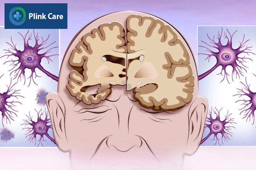 bệnh teo não gây mất các tế bào não