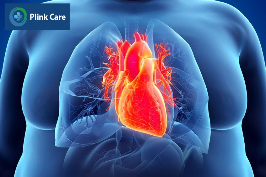 Tại sao béo phì lại tăng huyết áp? Béo phì gây tăng huyết áp, rối loạn mỡ máu