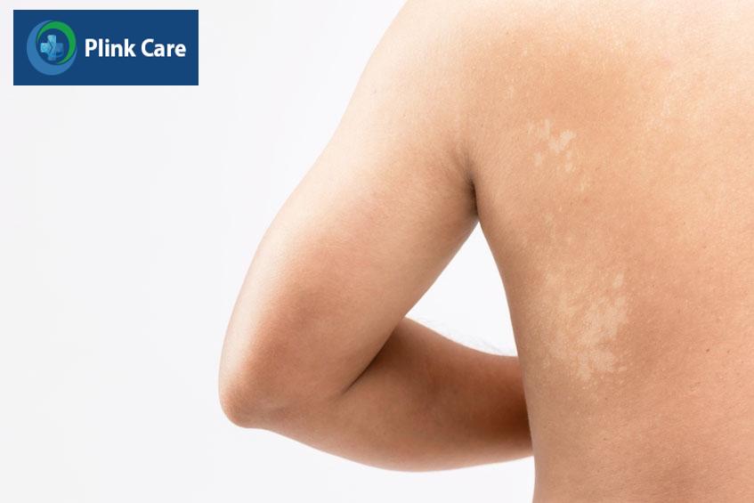 bị lang ben ở lưng có nguy hiểm không