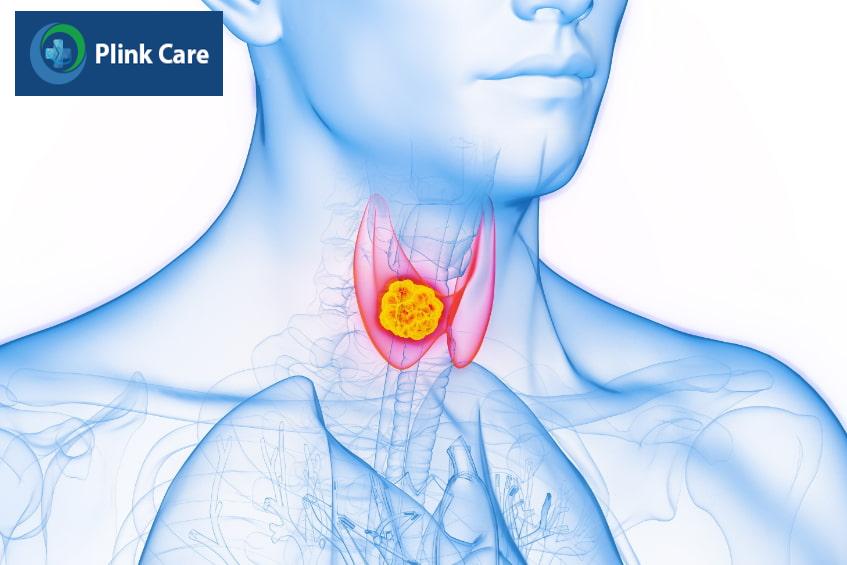 Một số lưu ý cho người bị u tuyến giáp