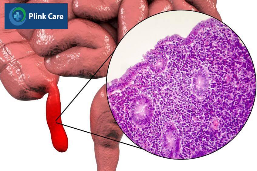 bị viêm phúc mạc ruột thừa