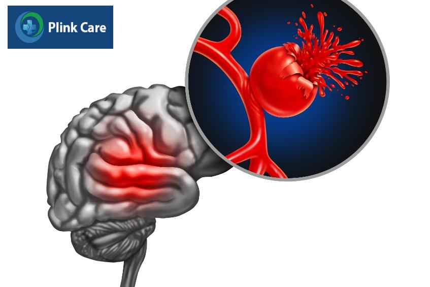 các loại xuất huyết não đều nguy hiểm