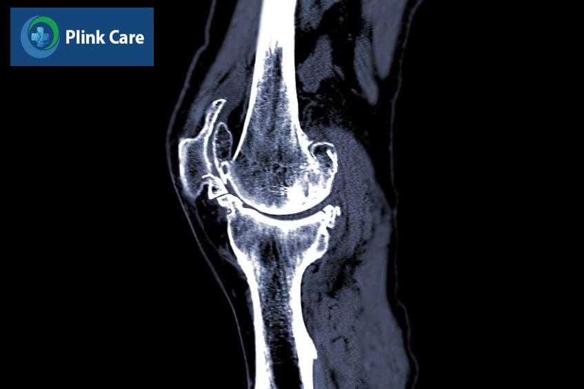 cách chẩn đoán khớp gối kêu lục cục