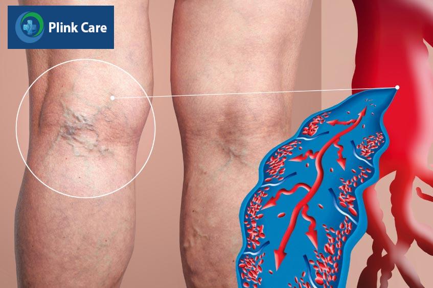 Chân của bệnh nhân bị huyết khối tĩnh mạch sâu với các đường mạch máu hiện rõ