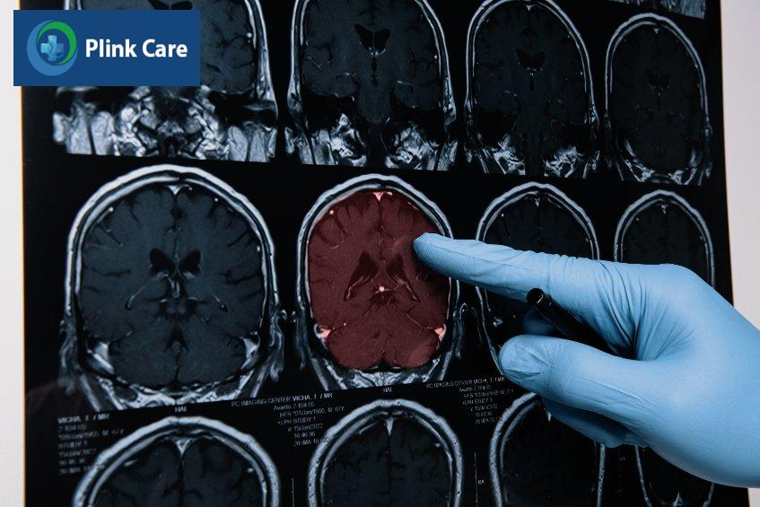 chẩn đoán và can thiệp điều trị xuất huyết não kịp thời