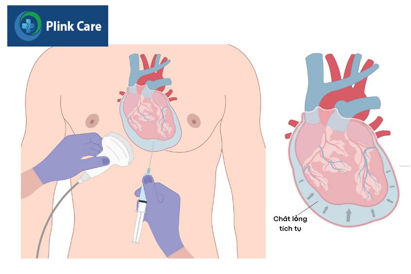 Chọc hút dịch màng ngoài tim giúp loại bỏ chất dịch gây chèn ép tim