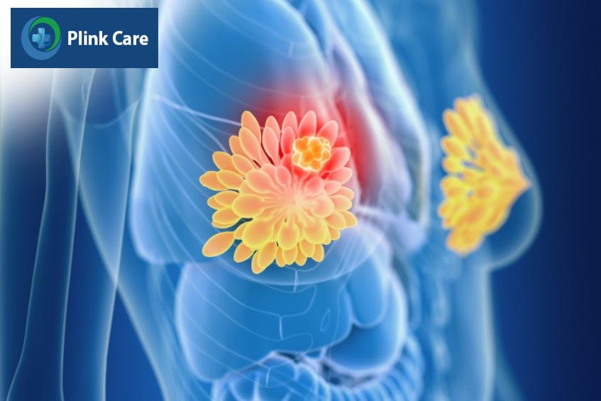 chụp mri vú và chụp nhũ ảnh