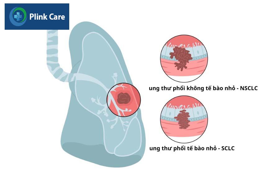 Có 2 loại ung thư phổi
