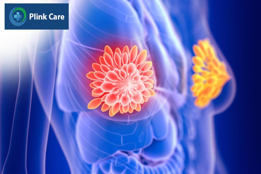 Có thể mắc ung thư vú mà không có khối u không