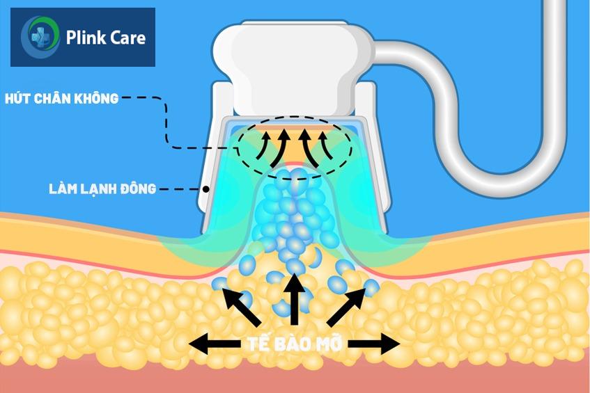 công nghệ đông hủy mỡ