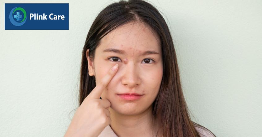 dấu hiệu bị mụn cứng dưới da
