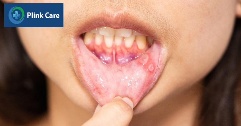 dấu hiệu nhiệt miệng
