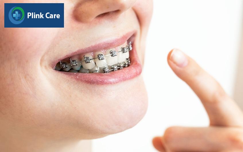Cách chữa răng mọc lệch, niềng răng