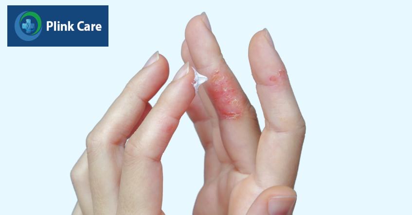 điều trị viêm da cơ địa ở tay